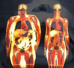 Internal Fat on the Body