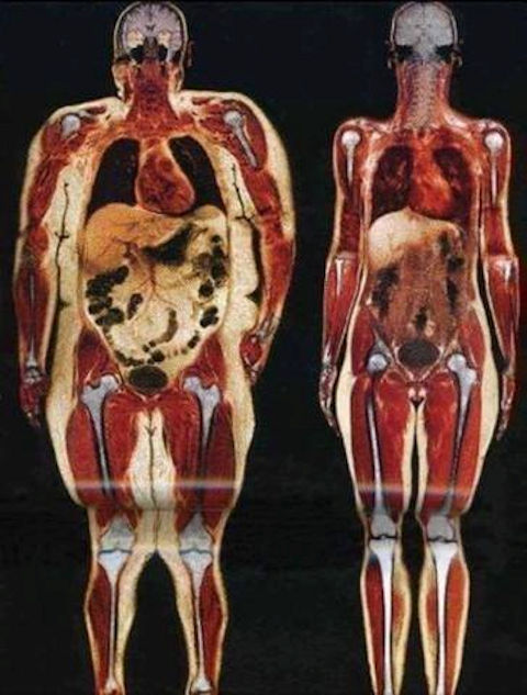obesity